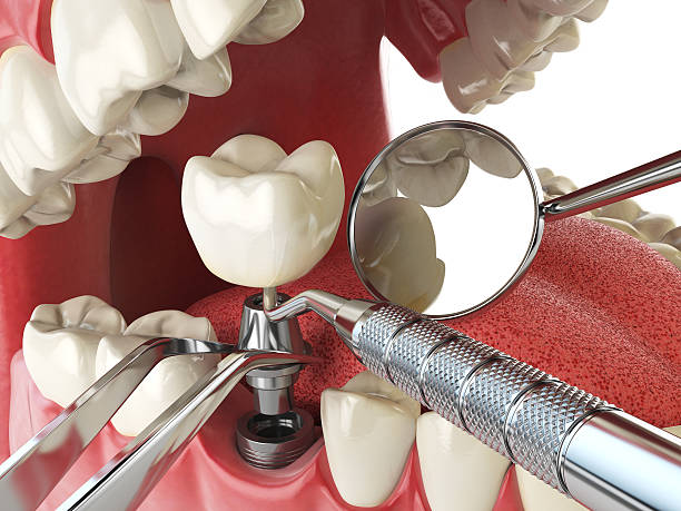 Best Emergency Dental Care for Broken or Chipped Teeth in Fort Morgan, CO